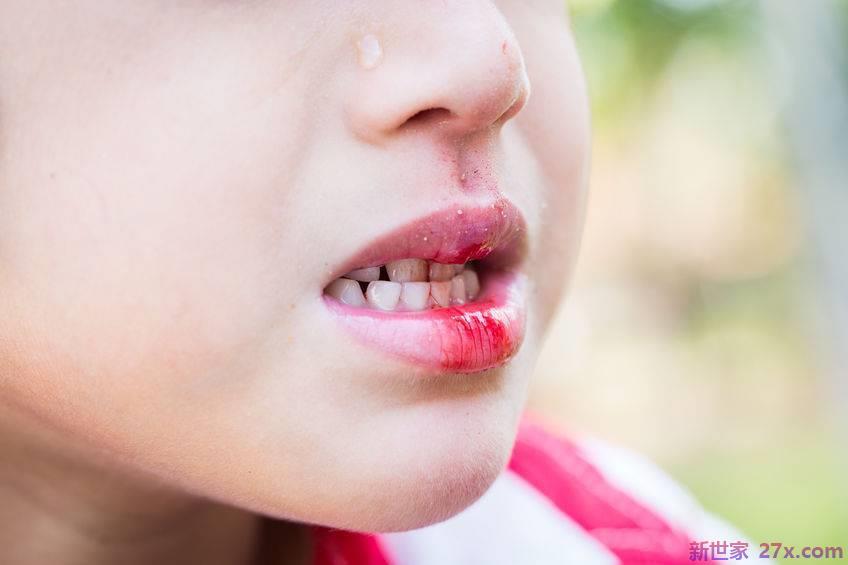 为什么白血病会导致牙龈出血？提醒:除了出血，大部分都伴有这三种症状。