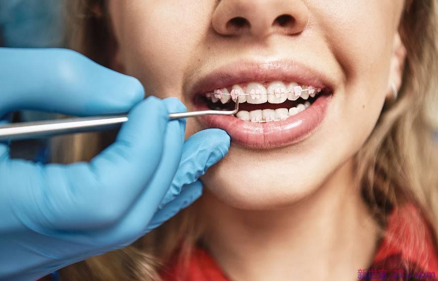 正畸后害怕戴牙套？如果出现这四种现象，可能会更难看。