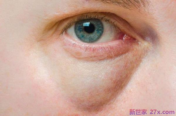 要去做眼袋去除手术？别急，允许医生告诉你这三点注意事项。