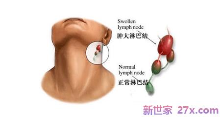 淋巴结为什么会肿？